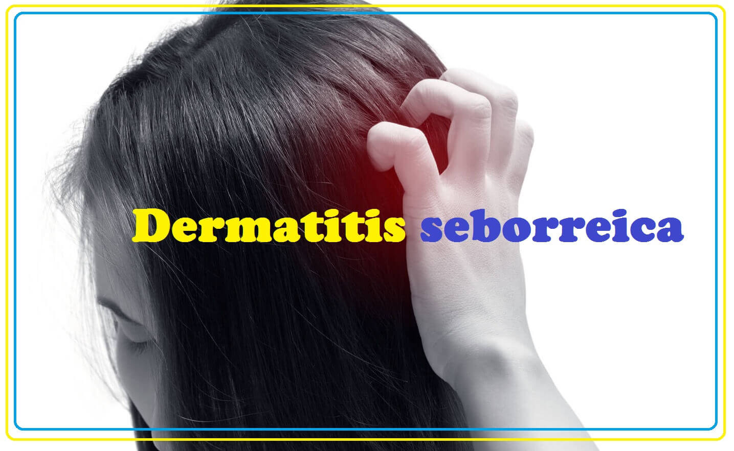 Dermatitis seborreica de cuero cabelludo